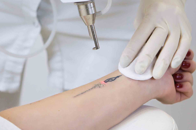 Laser_for_Tattoo_Removal